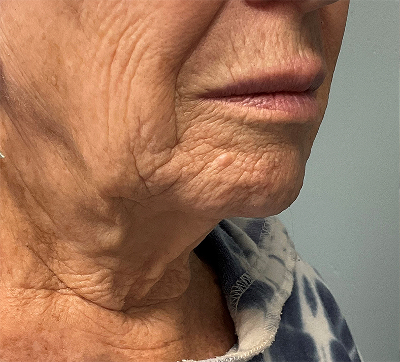 UltraClear frakcijski laser - sl. 6, prije