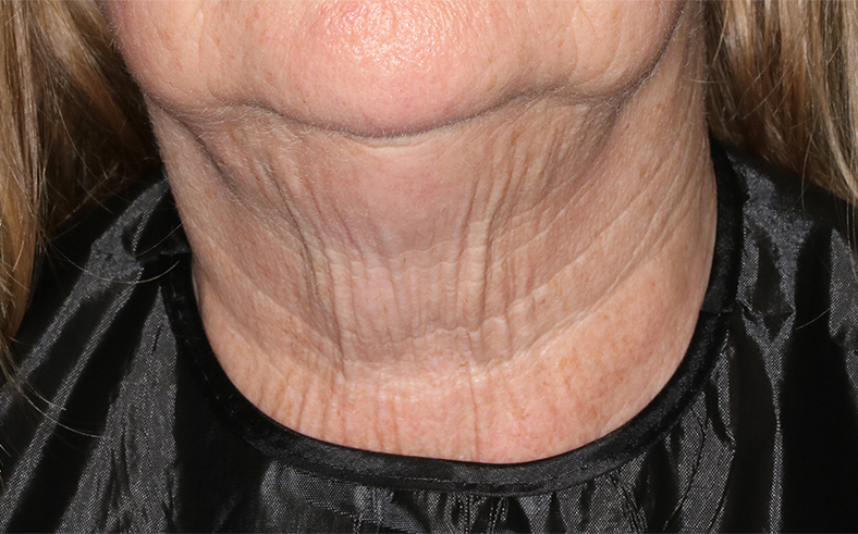 UltraClear frakcijski laser - sl. 8, prije