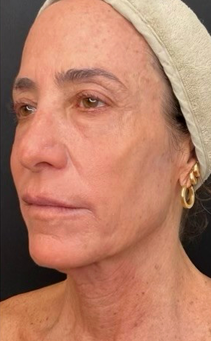 UltraClear frakcijski laser - sl. 9, poslije