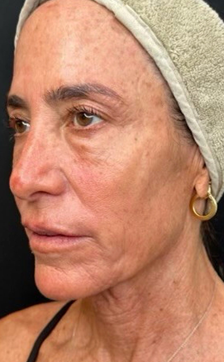 UltraClear frakcijski laser - sl. 9, prije