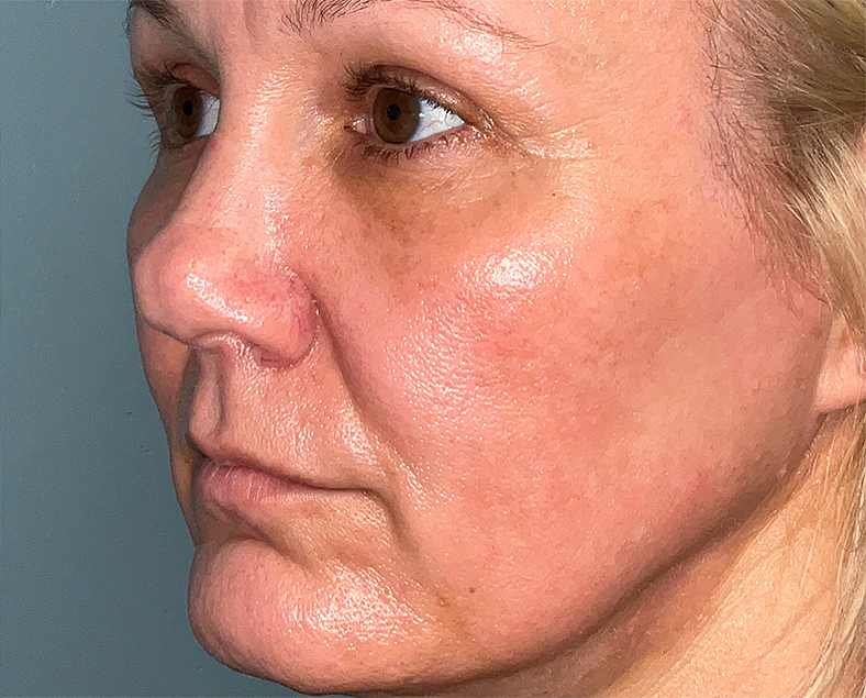 UltraClear frakcijski laser - sl. 10, poslije