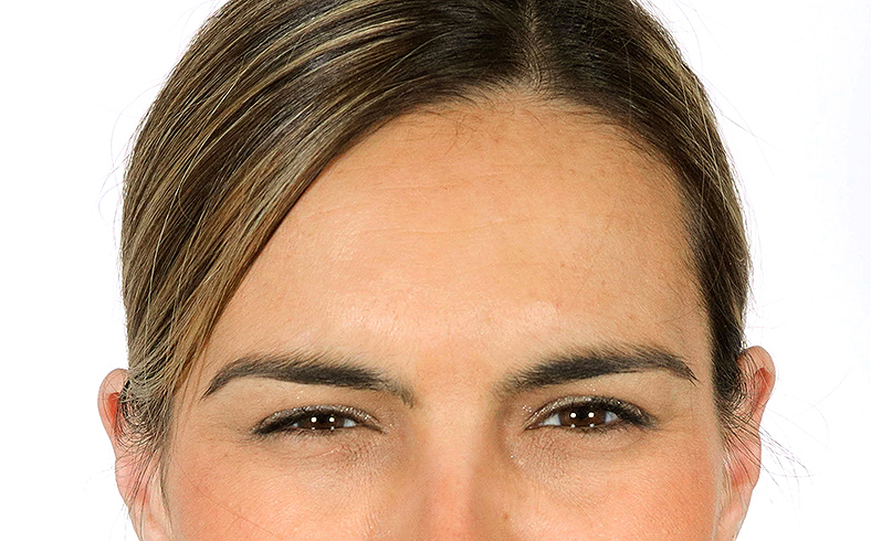 Injekcije za bore, Botox, sl. 1 - poslije