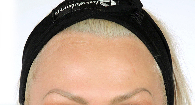 Injekcije za bore, Botox, sl. 2 - poslije