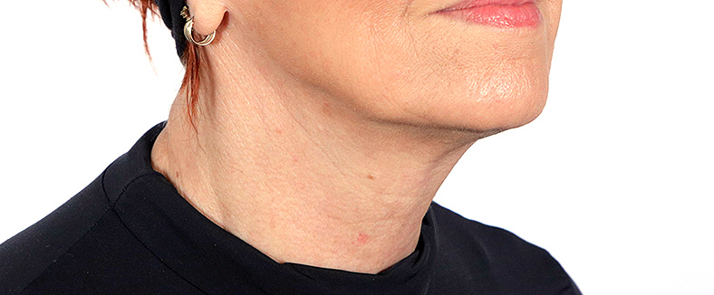 Injekcije za bore, Botox, sl. 3 - poslije