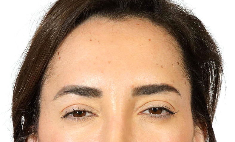 Injekcije za bore, Botox, sl. 1 - poslije