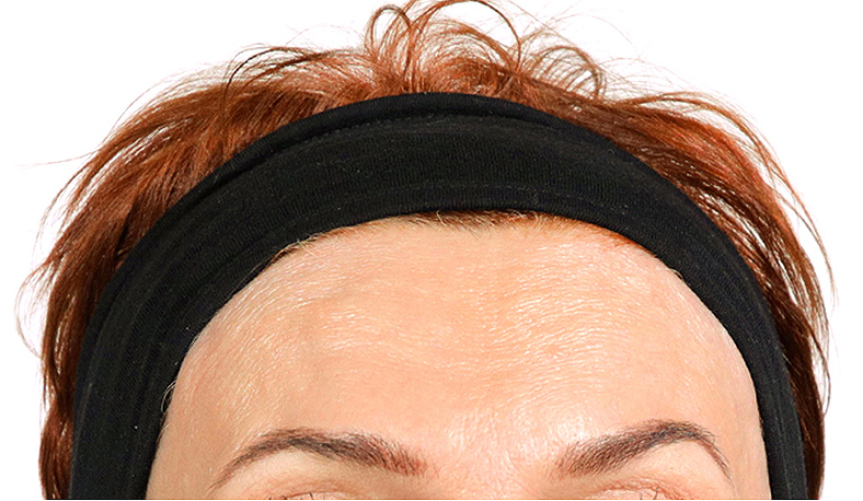 Injekcije za bore, Botox, sl. 2 - poslije