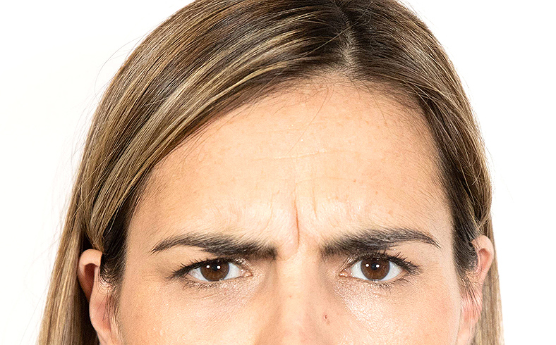 Injekcije za bore, Botox, sl. 1 - prije