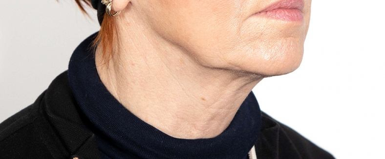 Injekcije za bore, Botox, sl. 3 - prije