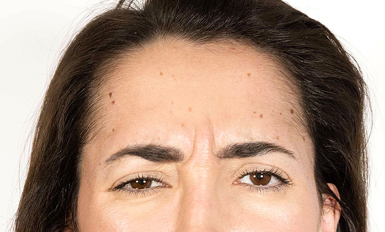 Injekcije za bore, Botox, sl. 1 - prije