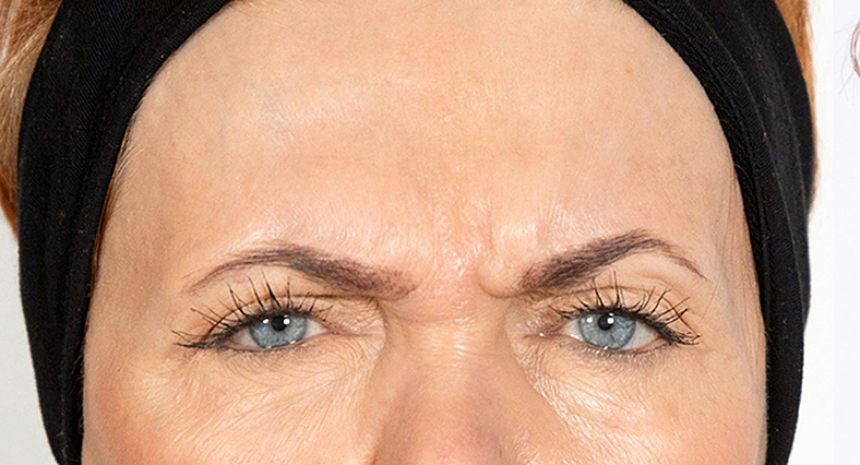 Injekcije za bore, Botox, sl. 1 - prije