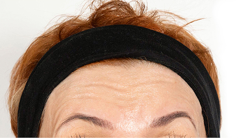 Injekcije za bore, Botox, sl. 2 - prije